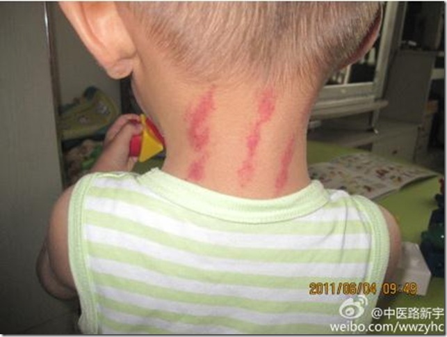 @中医路新宇 吮痧&mdash;&mdash;防治小儿风寒感冒初起