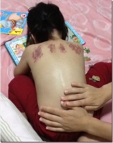 [经验分享]一位妈妈治疗小儿支气管炎的经历