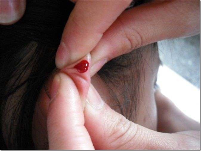 【刺络】耳尖放血可以治疗的疾病