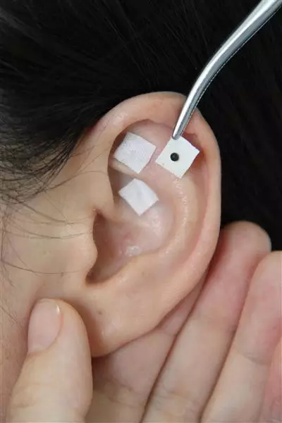 耳穴贴压 压豆 王不留行