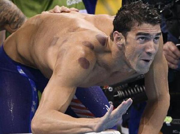 拔罐治病有神功（by 董洪涛）